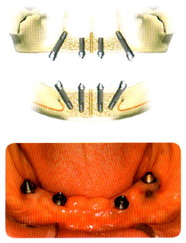 All-on-4によるインプラントの配置