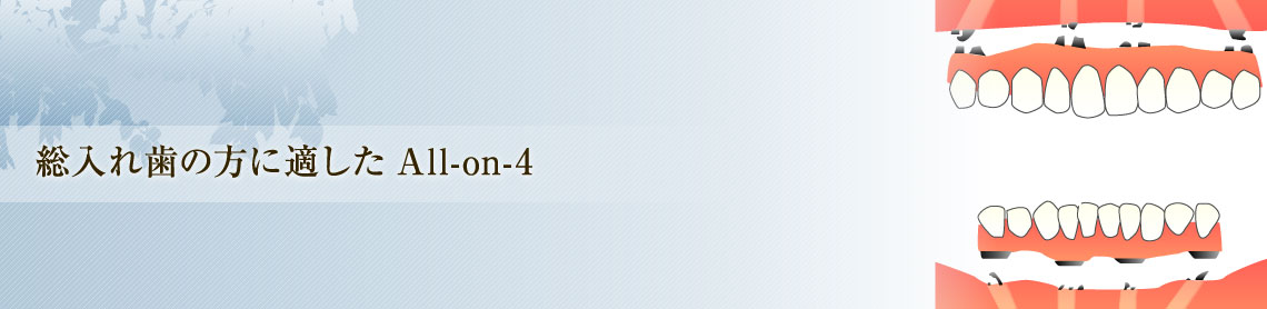 総入れ歯の方に適したAll-on-4
