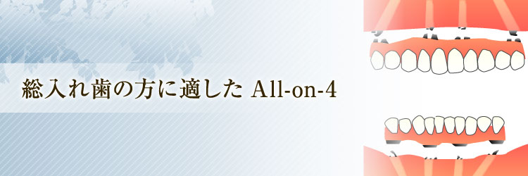総入れ歯の方に適したAll-on-4