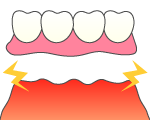 入れ歯の場合