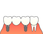 インプラント