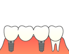 インプラント
