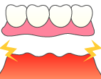 入れ歯の場合