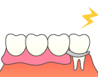 部分入れ歯の場合