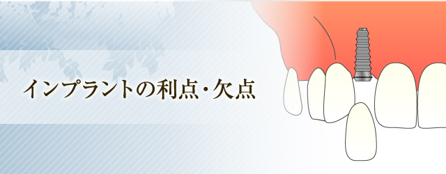 インプラントの利点・欠点