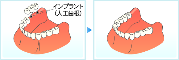 数本の歯を無くした場合