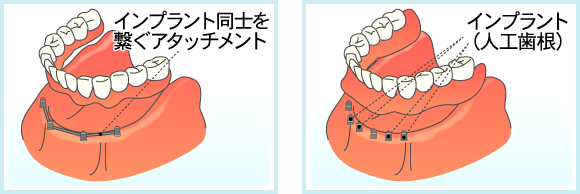 上アゴまたは下アゴの歯をすべて無くした場合