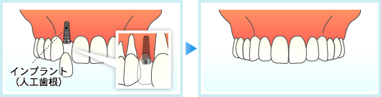 インプラントなら周囲の健康な歯を削ることなく、治療することができます。